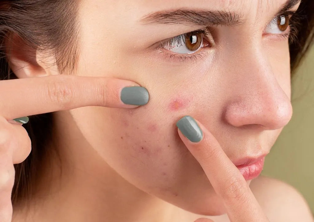 Manchas de Acne: Como Clarear e Uniformizar a Pele (Guia Completo)