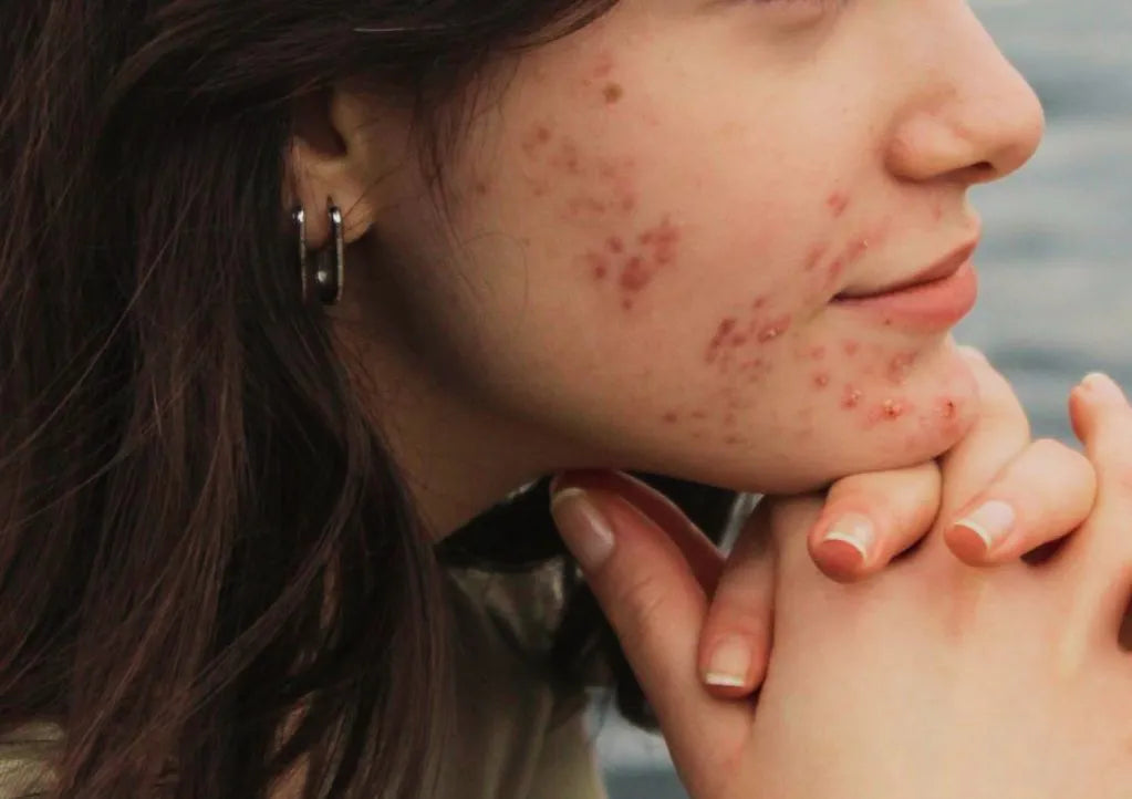 Rotina de Skincare para Acne: o Passo a Passo Completo (Dia e Noite)